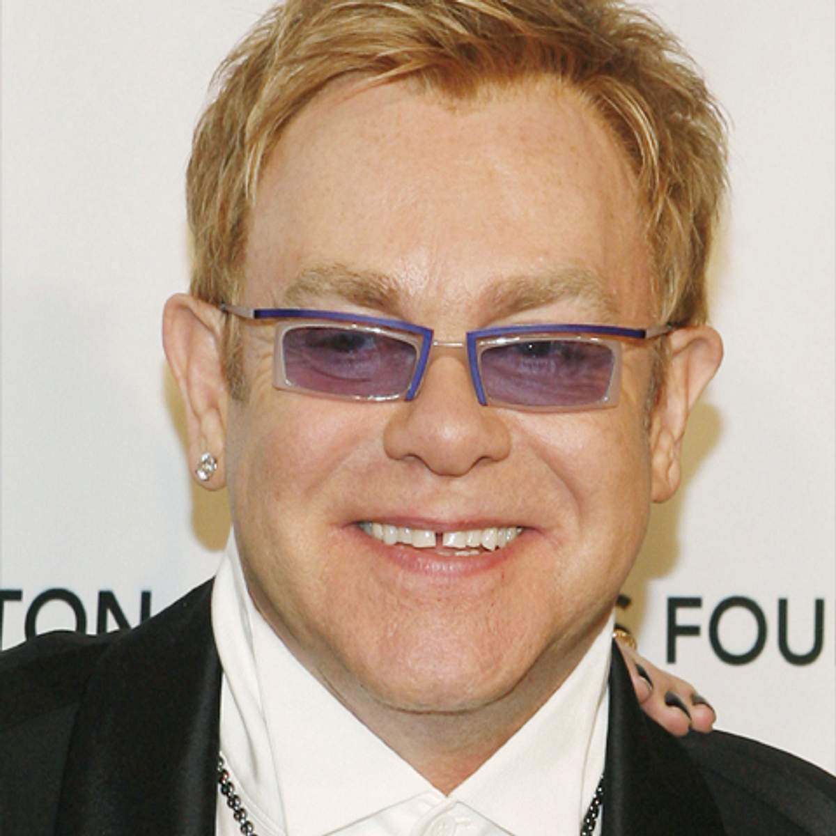 Schönheitsmakel der Stars Elton John