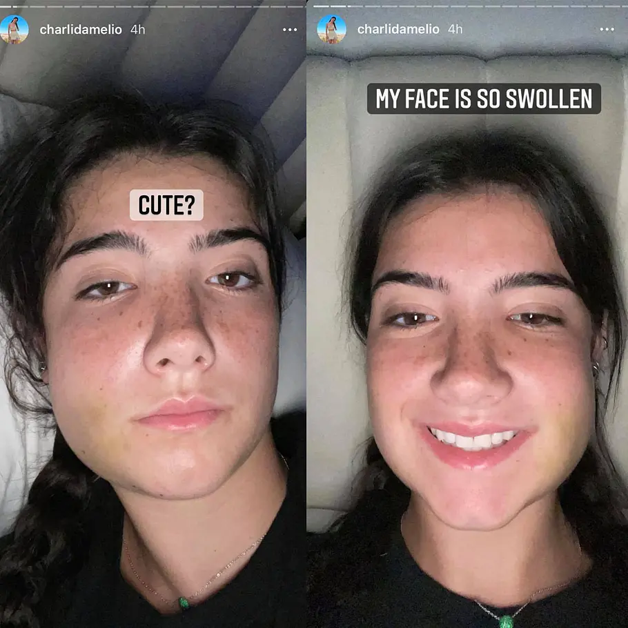 Charli D'Amelio geschwollenes Gesicht nach OP