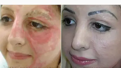 Die Narben sind kaum noch sichtbar! - Foto: http://basmahameed.com/paramedical/burns.php