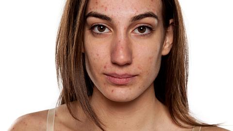 Pickel was hilft - Foto: iStock