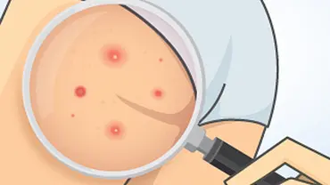 Pickel am Po: So wirst Du sie los! - Foto: iStock Pickel am Po: So wirst Du sie los! - Foto: iStock