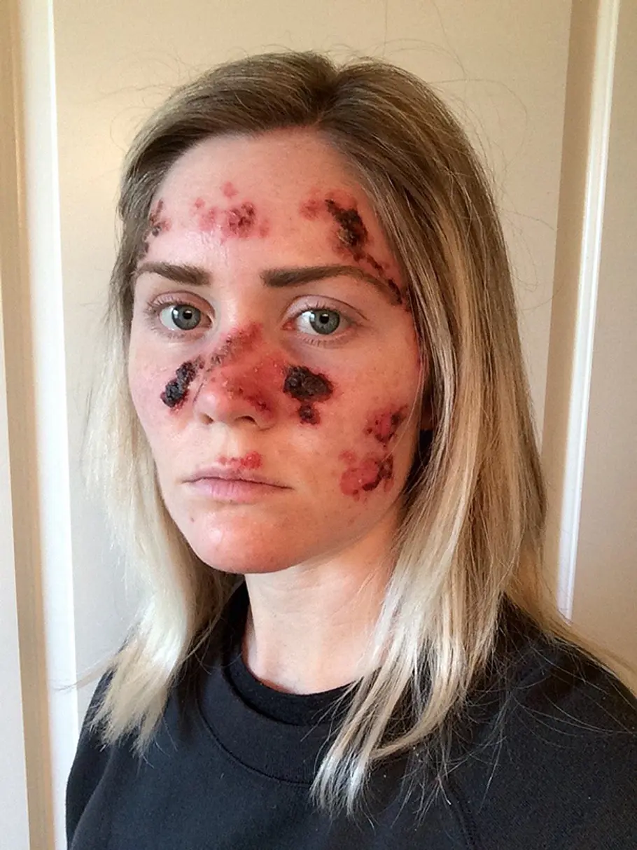 skin cancer tanning bed tawny willoughby 1